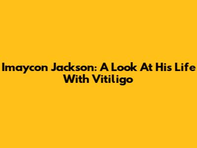 Imaycon Jackson: A Look At His Life With Vitiligo